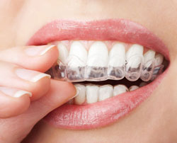 hand holding Invisalign clear aligners in mouth Urbana, MD
