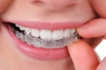 Tigani orthodontic-aligners